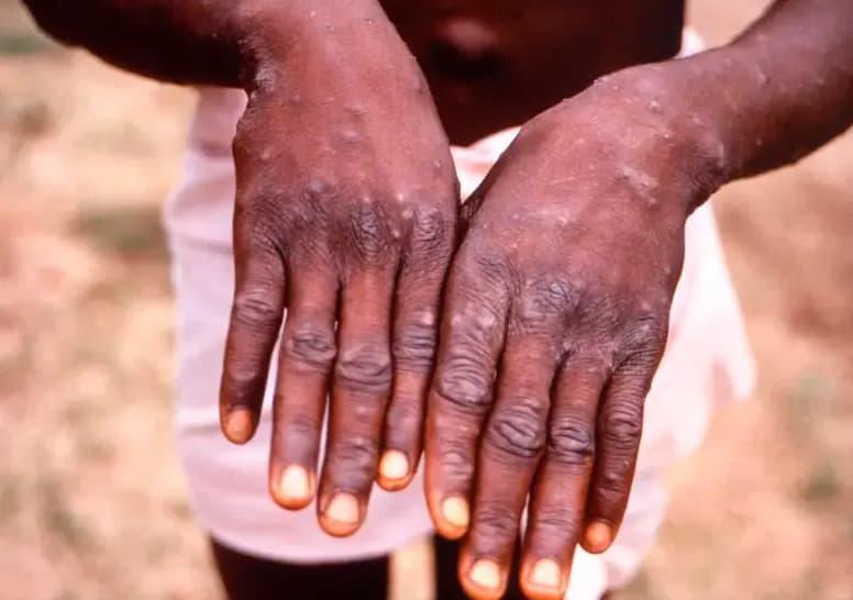 Bello reporta 16 casos positivos de viruela símica y hace llamado a la prevención