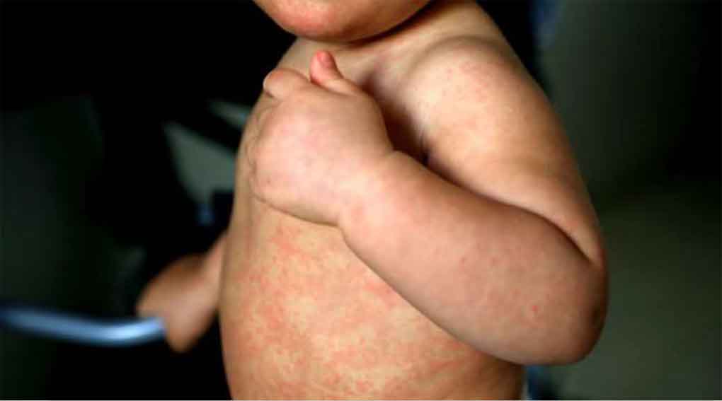 La postura antivacunas de EEUU responsable del aumento de sarampión en todo el continente, dicen los expertos