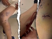 Impunidad a mordidas: sobrevive al ataque de una jauría y en la FGE le sugieren envenenarlos