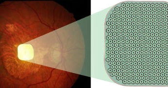 Tiny eye implant, special glasses help some legally blind patients read again