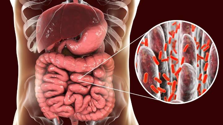 El sobrecrecimiento bacteriano del intestino delgado, una dolencia al alza