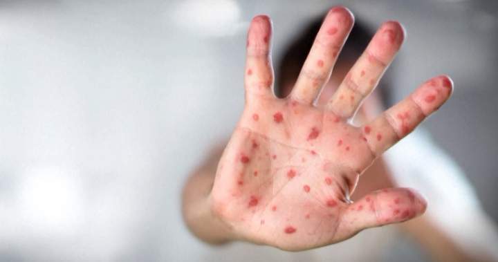 Premature baby dies from measles in Alberta as cases throughout province near 2,000