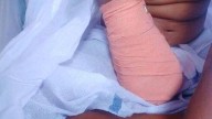 Girl's right hand amputated following lapses in medical treatment: Doctors at Palakkad District Hospital suspended