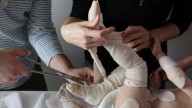 Piel de mariposa: cuando la barrera protectora del cuerpo sufre. Afecta a miles en el mundo y lucha por visibilizarse en Colombia