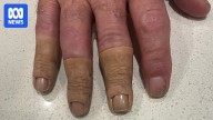 Prosthetics clients of Jack McDonald question what legal rights they have for compensation