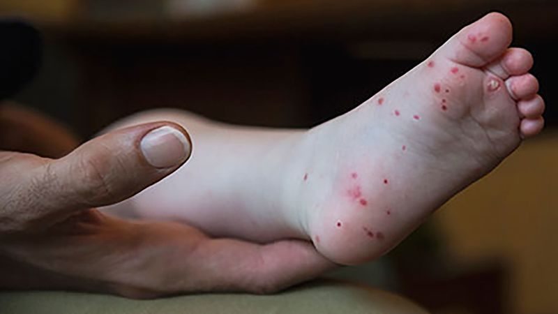 Hand, food and mouth disease is on the rise in certain areas. A doctor explains symptoms and treatment