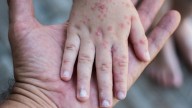 Afecta Coxsackie a más de 300 chihuahuenses