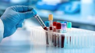 FDA clears blood test to help rule out Alzheimer's disease in people showing symptoms