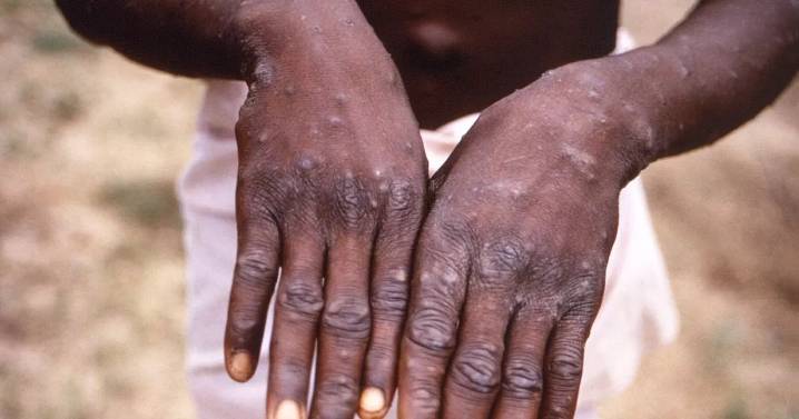 Mpox symptoms explained as warning issued over 'global spread' of infection