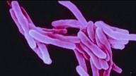 NH health officials identify 2 new tuberculosis cases in Manchester, Nashua