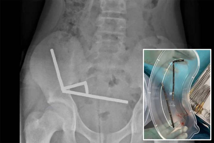 13-year-old boy has emergency surgery after swallowing 100 magnets