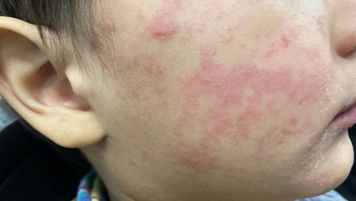 150+ unvaccinated kids quarantine as measles surge across the U.S.
