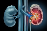 Shift Work Positively Associated With Kidney Stone Events
