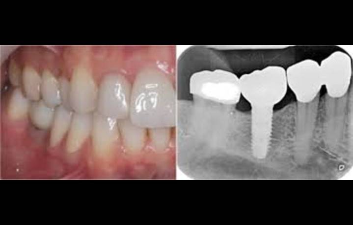 Intermediate Abutment-Healing Cap System Ensures Accurate Single Implant Scans, suggests study