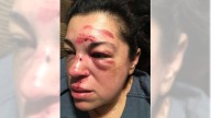 Teacher wins $7.5 million in settlement with city of Whittier over fall on sidewalk