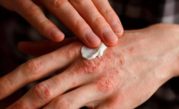 Psoriasis en Argentina: diagnóstico, tratamiento y concientización