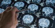 Denuncian dificultades de acceso a nuevas terapias para el glioblastoma