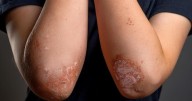 FDA Approves Tremfya for Pediatric Plaque Psoriasis, Active Psoriatic Arthritis
