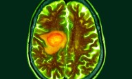 AI distinguishes glioblastoma from look-alike cancers during surgery: Study