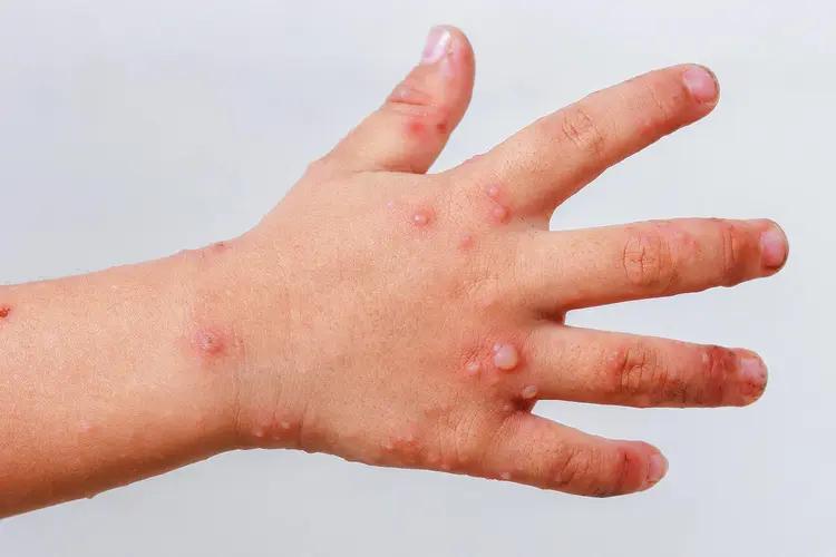Autoridades cierran dos escuelas más en el Valle Central de #Oaxaca por nuevos casos de virus Cocksakie