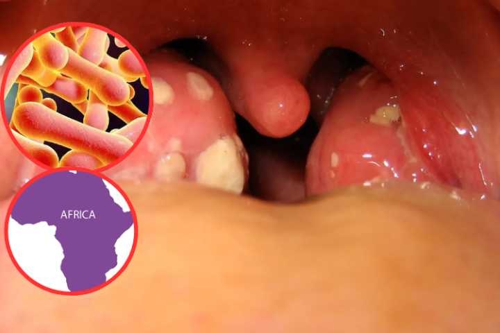 resurge la difteria en áfrica: una enfermedad mortal que vuelve a causar alarma