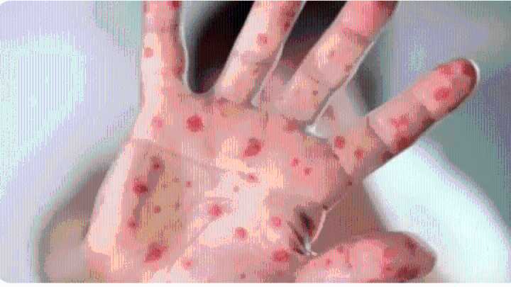 Tomato flu alert in Uttarakhand: 28 child cases confirmed, health dept issues warning