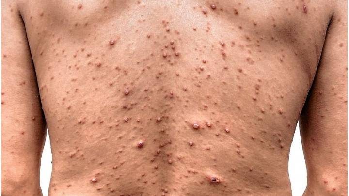 Brote de varicela en Entre Ríos: hay 700 casos y la mayoría son adolescentes