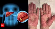 Liver damage warning signs visible on your hands; here’s what you need to know