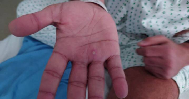 Detectan casos más severos de viruela del mono en EU; ¿son similares a los de México?