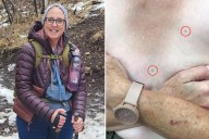 Cancer left me with tattoos I never asked for: How I reclaimed my body