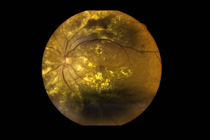 Retinal Implant Helps Restore Vision in Macular Degeneration Patients