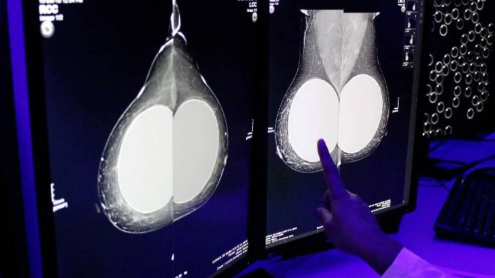 Sheinbaum anuncia Modelo de Atención Universal de Cáncer de Mama: Es un antes y un después en la salud pública