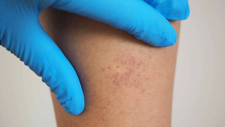 Nuevo León registra alza de 42.1% en casos de leucemia en 2025; acumula 135