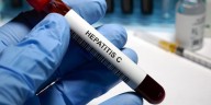 Hepatitis C: causas, síntomas, diagnóstico y tratamiento de esta enfermedad curable