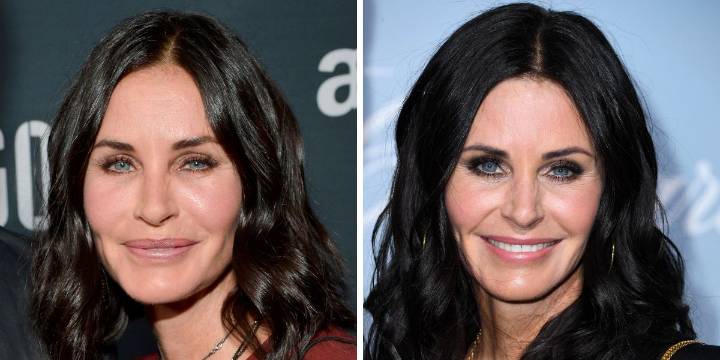 11 Celebrities Who Dissolved Their Fillers or Stopped Getting Them
