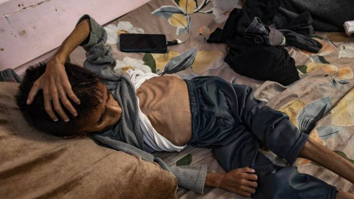 El demoledor informe sobre la desnutrición en Gaza: más de 54.600 niños menores de cinco años necesitan atención urgente