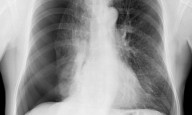 Pleural Abrasion Favored for Faster Recovery; Pleurectomy Reduces Recurrence Risk in Spontaneous...