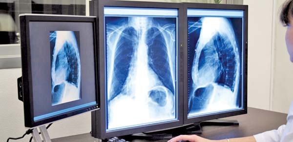 Descubren circuito molecular que controla la regeneración del pulmón