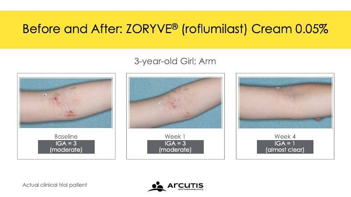 FDA Approves Zoryve for Atopic Dermatitis in Young Children