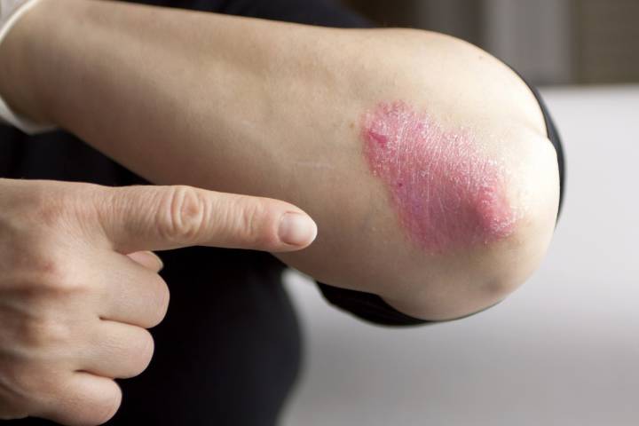 Cinco mitos y cinco verdades sobre la psoriasis