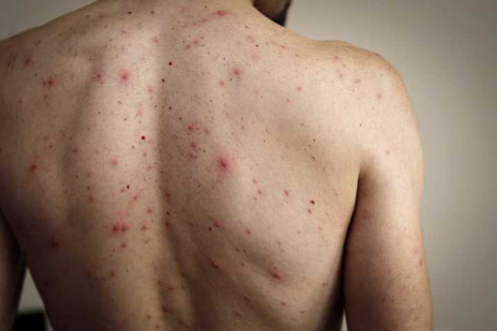 México registra 5,023 casos de sarampión y 23 muertes en lo que va de...