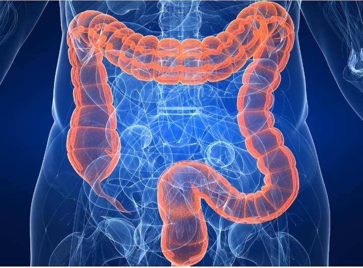 El segundo tipo más común. La Anmat autorizó una nueva terapia oral para pacientes con cáncer colorrectal avanzado