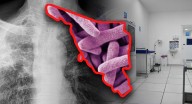 Sonora acumula mil 89 casos de tuberculosis en 2025: enfermedad puede afectar a cualquiera, tratamiento debe seguirse 6 meses, afirma especialista