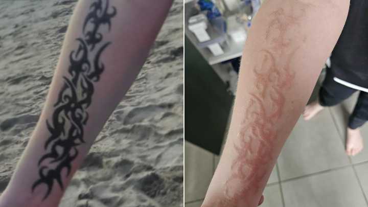 Mother’s dire warning for Bali holidaymakers after henna tattoo becomes permanent scar