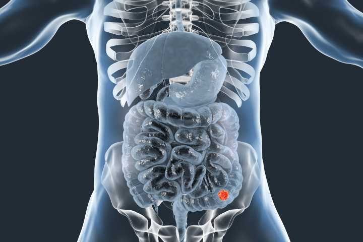 Speed vs. Certainty When it Comes to Expedited Regulatory Review of Colorectal Cancer Therapeutics