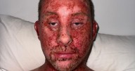 Man left with burning, oozing skin due to steroid cream withdrawal