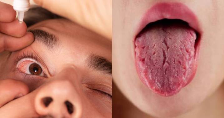 ¿Ojos y boca seca? Así afecta el síndrome de Sjögren según la UNAM