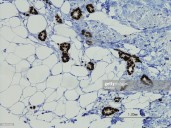 Experts Urge Rethinking Restrictions on Menopausal MHT After Breast Cancer