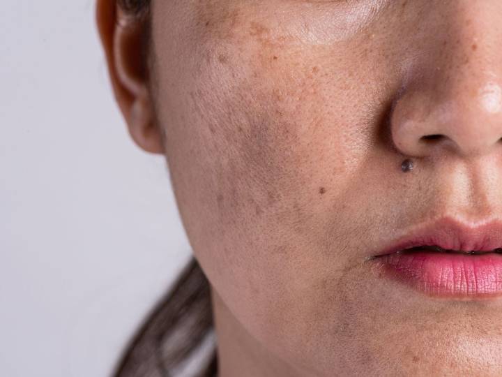 ¿Manchas en la piel? Estos son los ingredientes que ayudan a unificar el tono