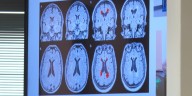 How $10M investment is funding Alzheimer’s research in SC